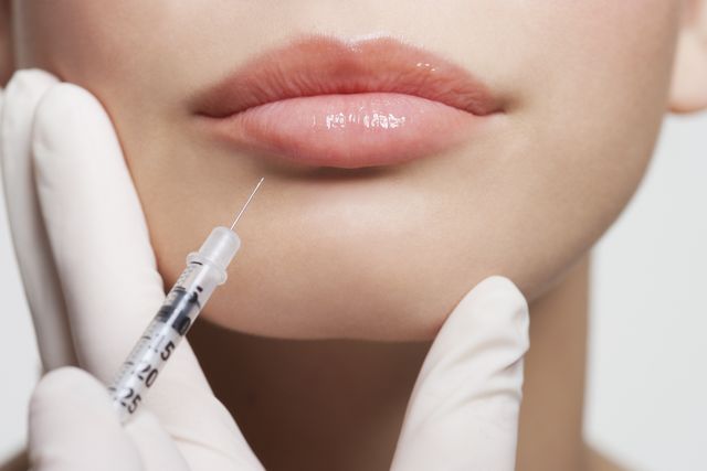 5 Things to Know Before You Getting Dermal Fillers