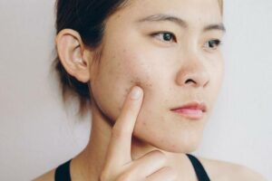 Camera-Ready Pimple Patches